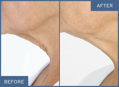 A Highly-Concentrated Formula Targeting Stubborn Jowls And Sagging Jawlines